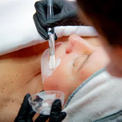 Peeling químico
