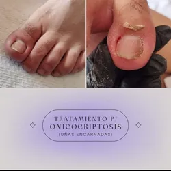 Tratamiento de uña encarnada