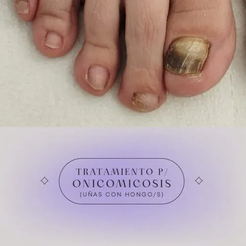 Tratamiento de uñas con hongos