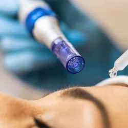 Microneedling - Dermapen