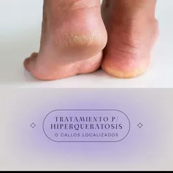 Tratamiento para hiperqueratosis
