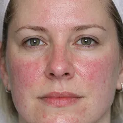 TRATAMIENTO PIEL SENSIBLE O CON ROSACEA