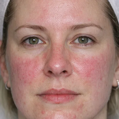 TRATAMIENTO PIEL SENSIBLE O CON ROSACEA