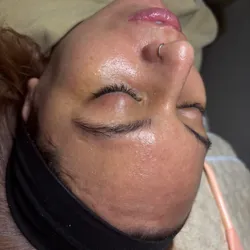 Peeling Quimico