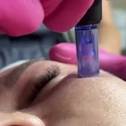 Limpieza + Dermapen