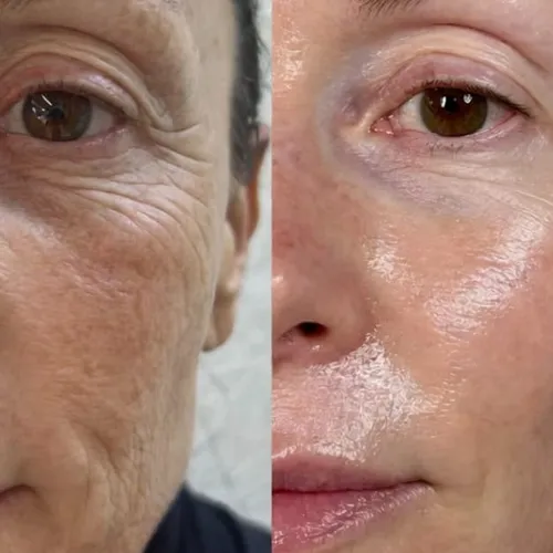 PDRN con Dermapen