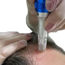 Meso Capilar con Dermapen