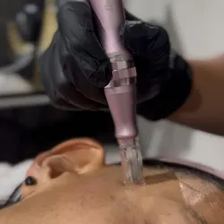Dermapen: Microneedling facial 