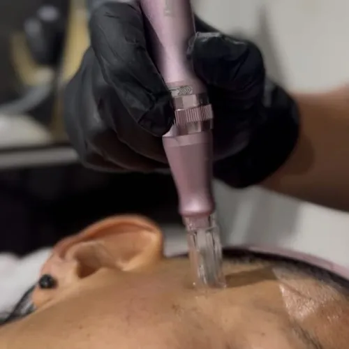 Dermapen: Microneedling facial 