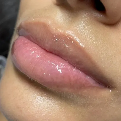 Dermapen: Microneedling labios