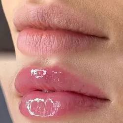 Hydralips