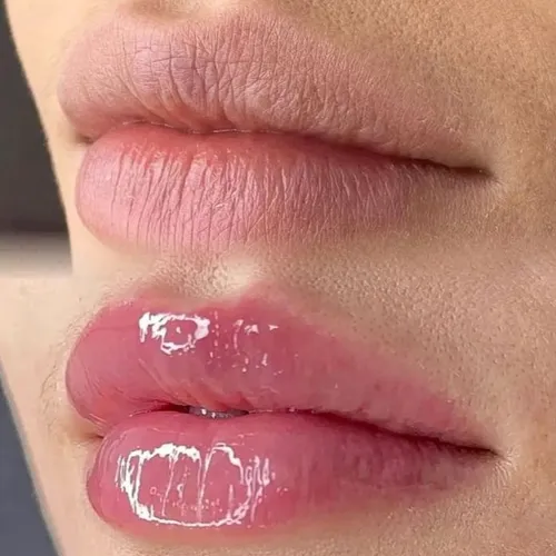 Hydralips