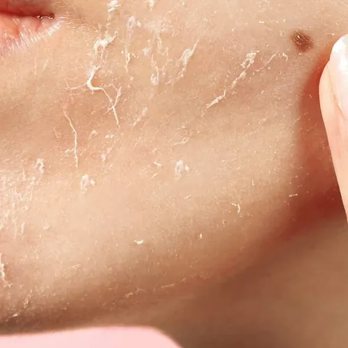 Yellow Peel/skin peel 