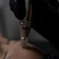 Microneedling 