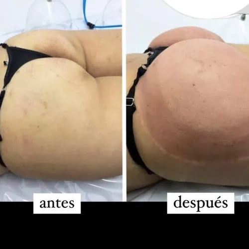 Vacumterapia 