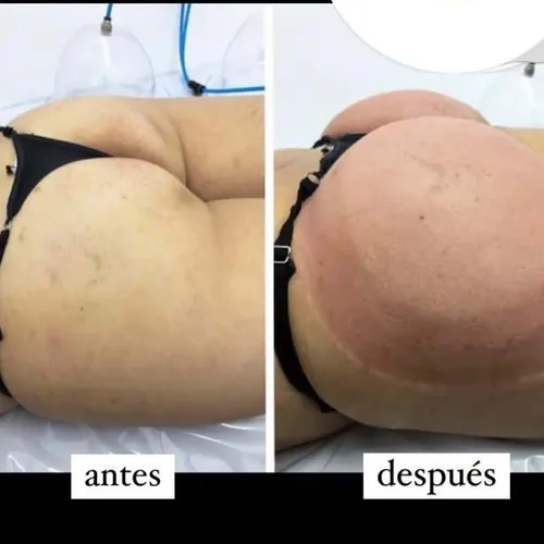 Promo vacum x10 sesiones 