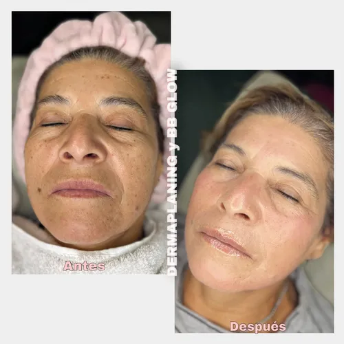 Dermaplaning + BB GLOW