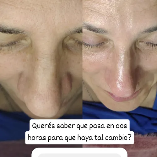 Objetivo: mejorar calidad de piel y arrugas de expresión 