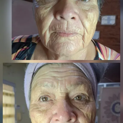 Tratamiento para arrugas