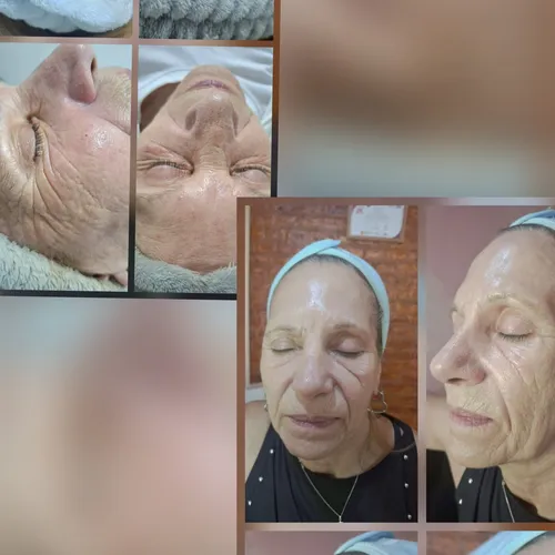 Tratamiento para arrugas