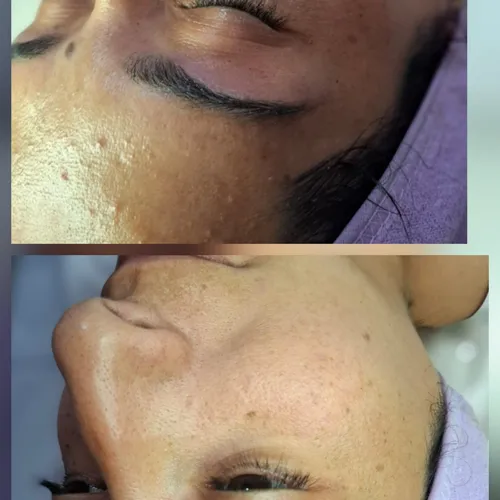 Limpieza facial+perfilados