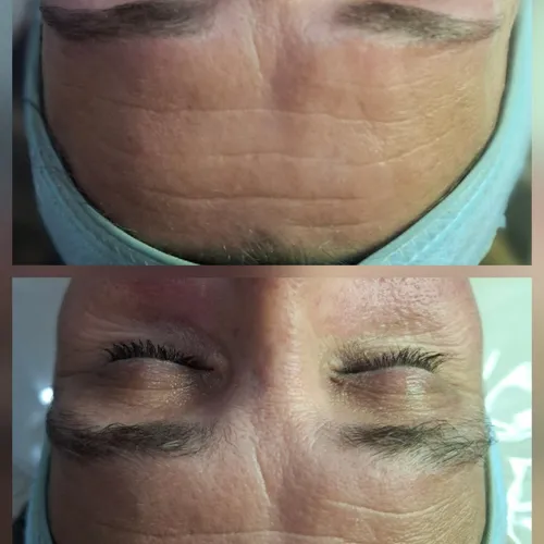 Limpieza facial + Perfilado