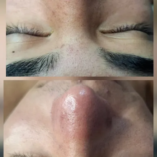 Limpieza facial 