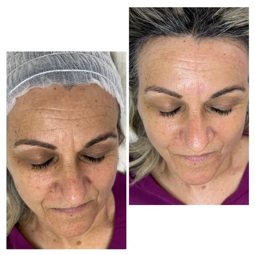 Higiene profunda + microneedling con activo regenerador. Buscamos suavizar líneas de la frente 