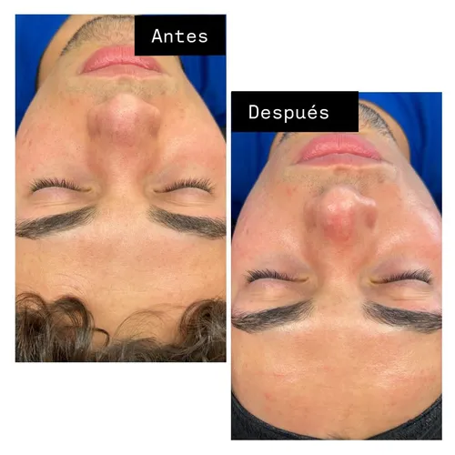 Higiene facial profunda 