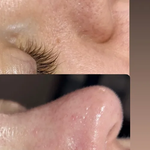Full extraciones