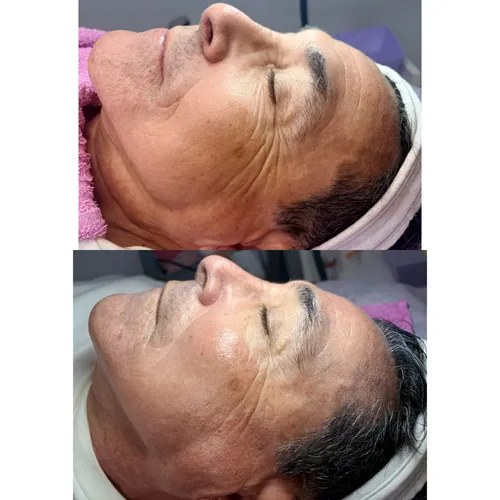 Hiegiene facial con extracciones yradio frecuencia 