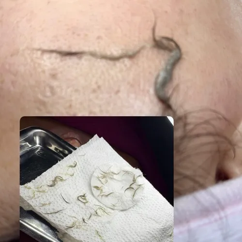 Dermaplaning