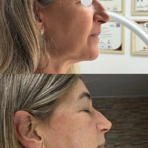 Hifu facial 