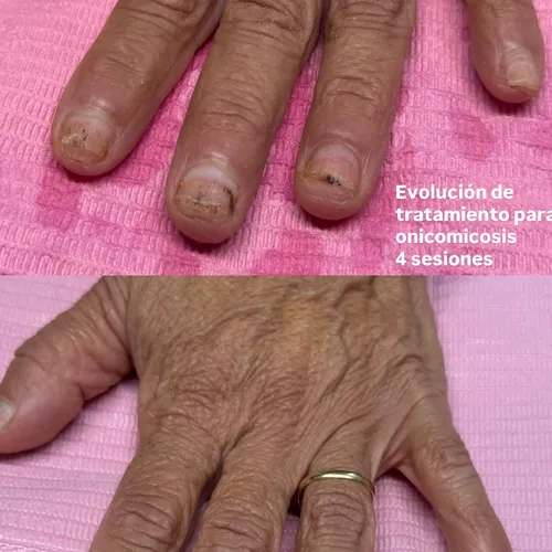 Láser onicomicosis 