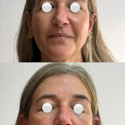 Hifu facial 