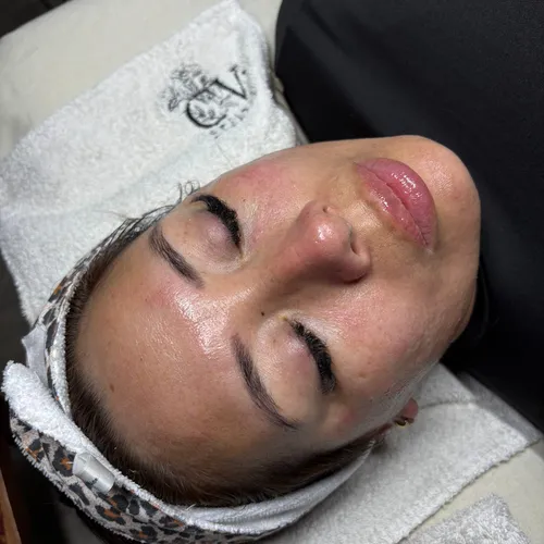 Dermapen con PDRN (ADN de Salmón) 
