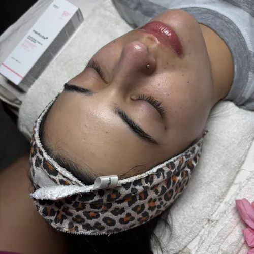 Post limpieza facial con dermapla