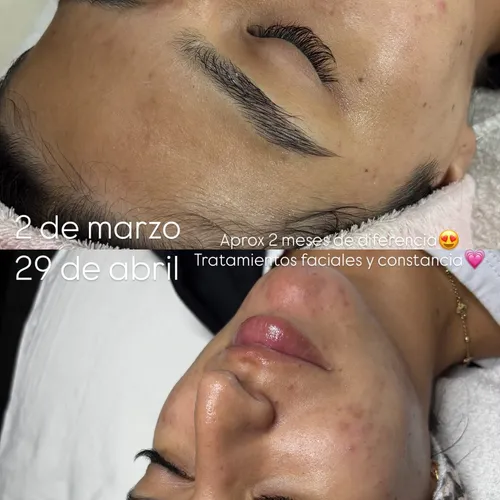 Antes y después de Tratamiento para Minimizar brotes y Pigmentaciones Post in