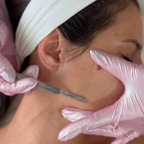 Dermaplaning con Radiofrecuencia