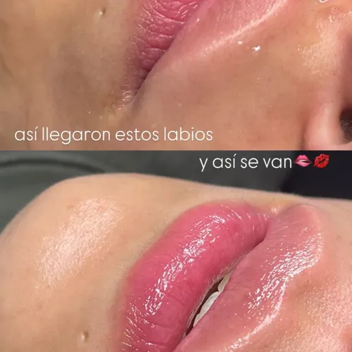 Labios bien juicyyy después de un hidralips