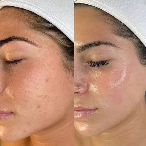 Dermaplaning 