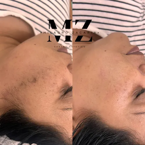 Dermaplaning 