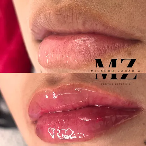 Hidra Lips