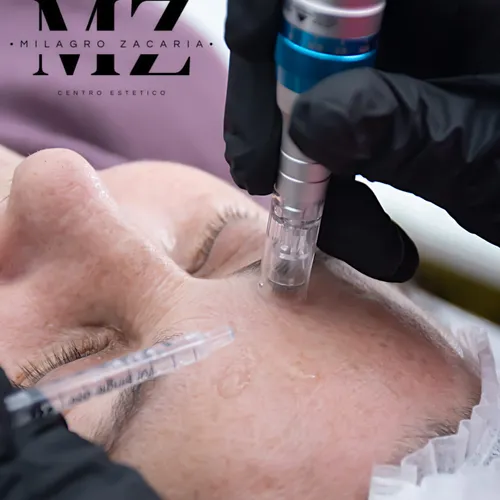 Microneedling