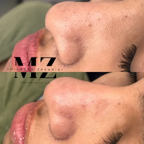 Una higiene facial con aparatos, un cambio en la primera sesion