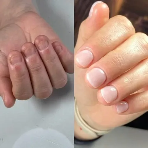 reconstrucción uñas comidas 