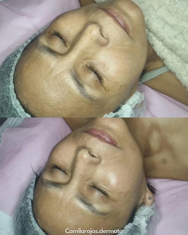 Radiofrecuencia facial, de Glow Lab