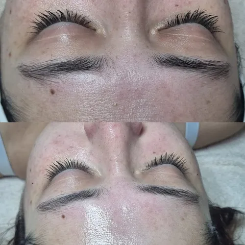 Acné & Rosácea, de Glow Lab