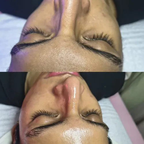 Microneedling Importado 🇰🇷, de Glow Lab