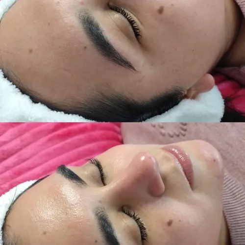 Dermaplaning + Peeling · Renovación Personalizada Dermaplaning combinado con un peeling seleccionado, de Bren.Nailstudy 